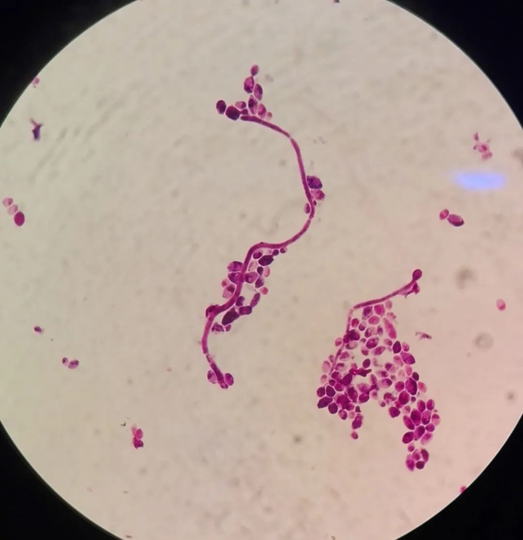 假丝酵母菌龟头炎症状图片