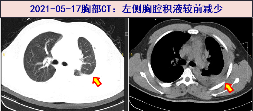 胸部CT2.png