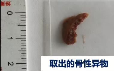 骨性异物.jpg