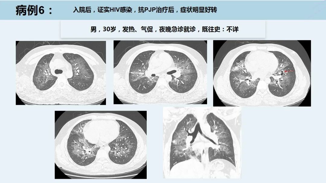 肺孢子菌肺炎图片