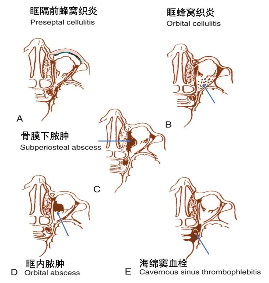 眼眶脓肿图片