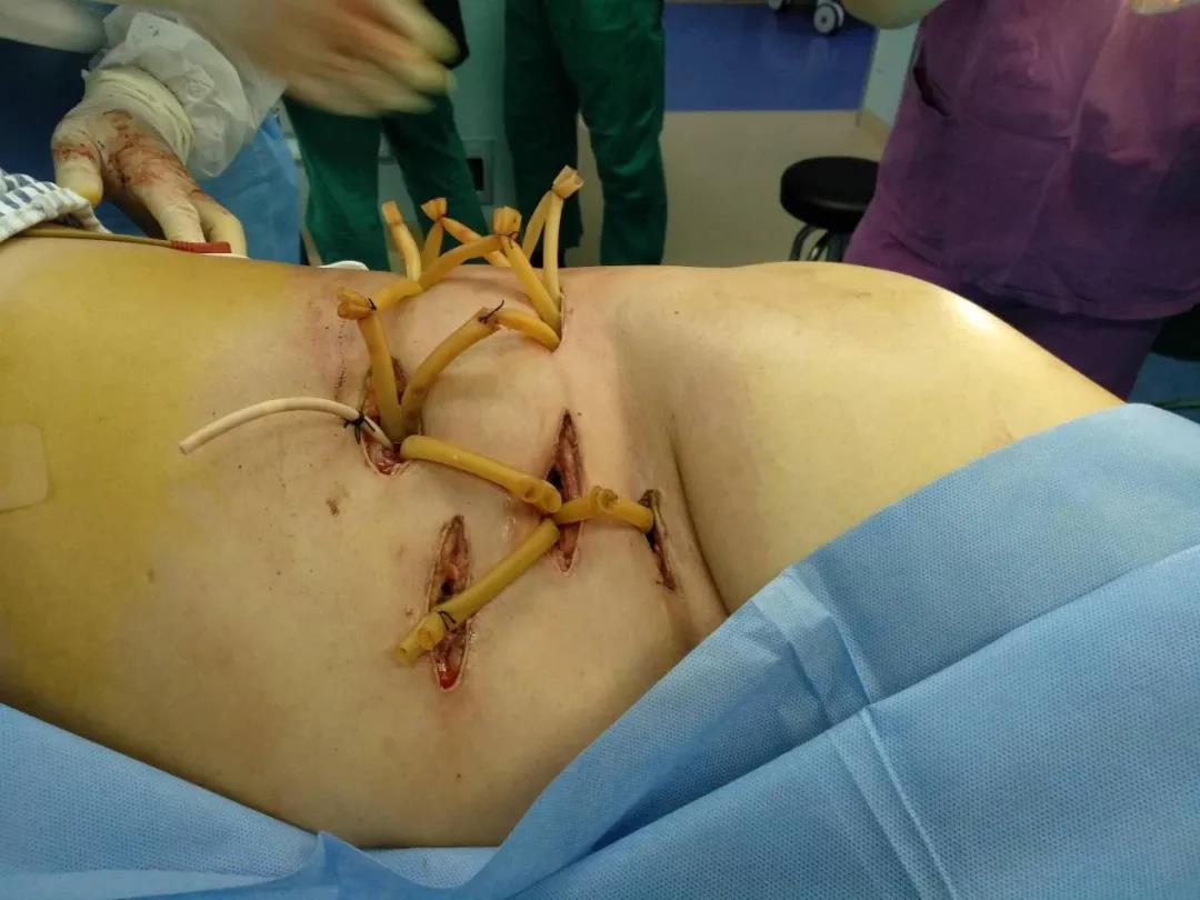 肛周脓肿术后恢复图图片