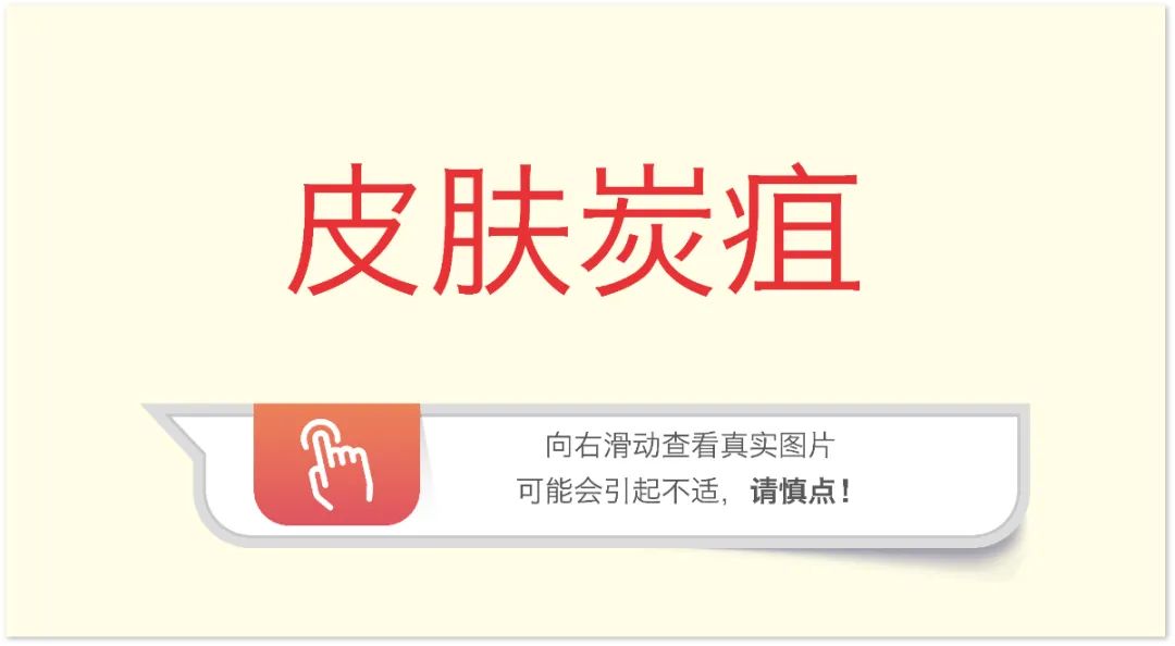 皮肤炭疽1.jpg