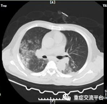 肺部CT3.png