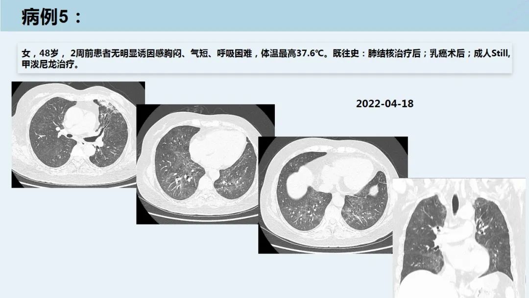 肺孢子菌肺炎图片