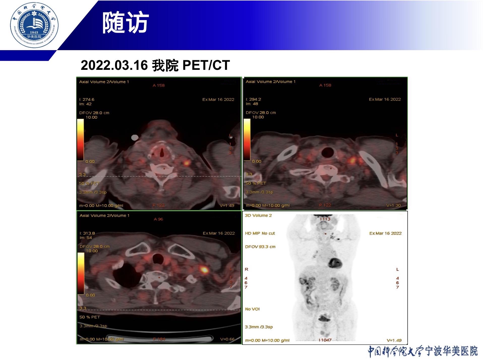 20220322+度伐利尤单抗+华金岳_21.jpg