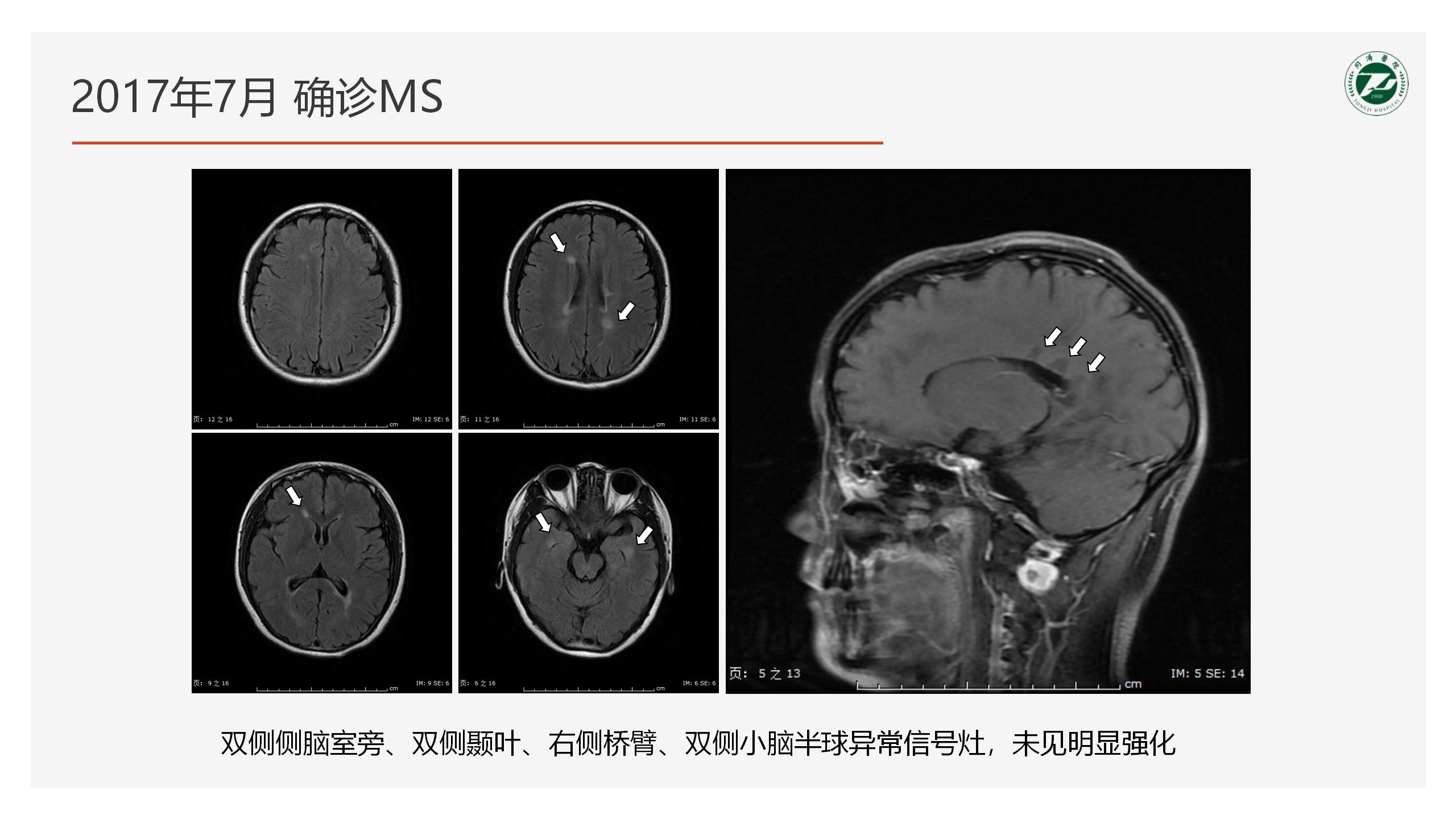 2023-4-21 奥巴捷区域沙龙《病例分享》黎钢_05.jpg