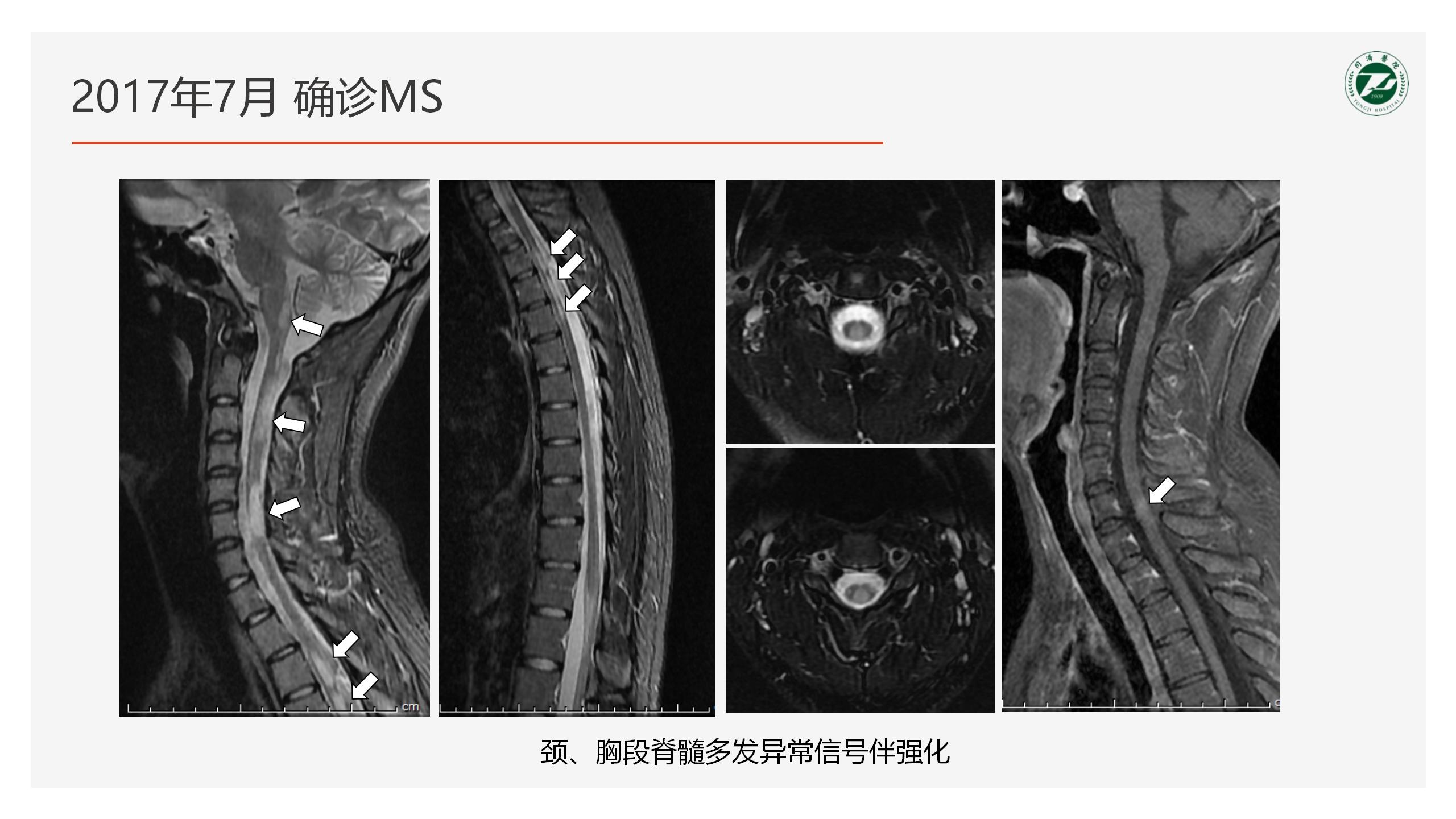 2023-4-21 奥巴捷区域沙龙《病例分享》黎钢_06.jpg