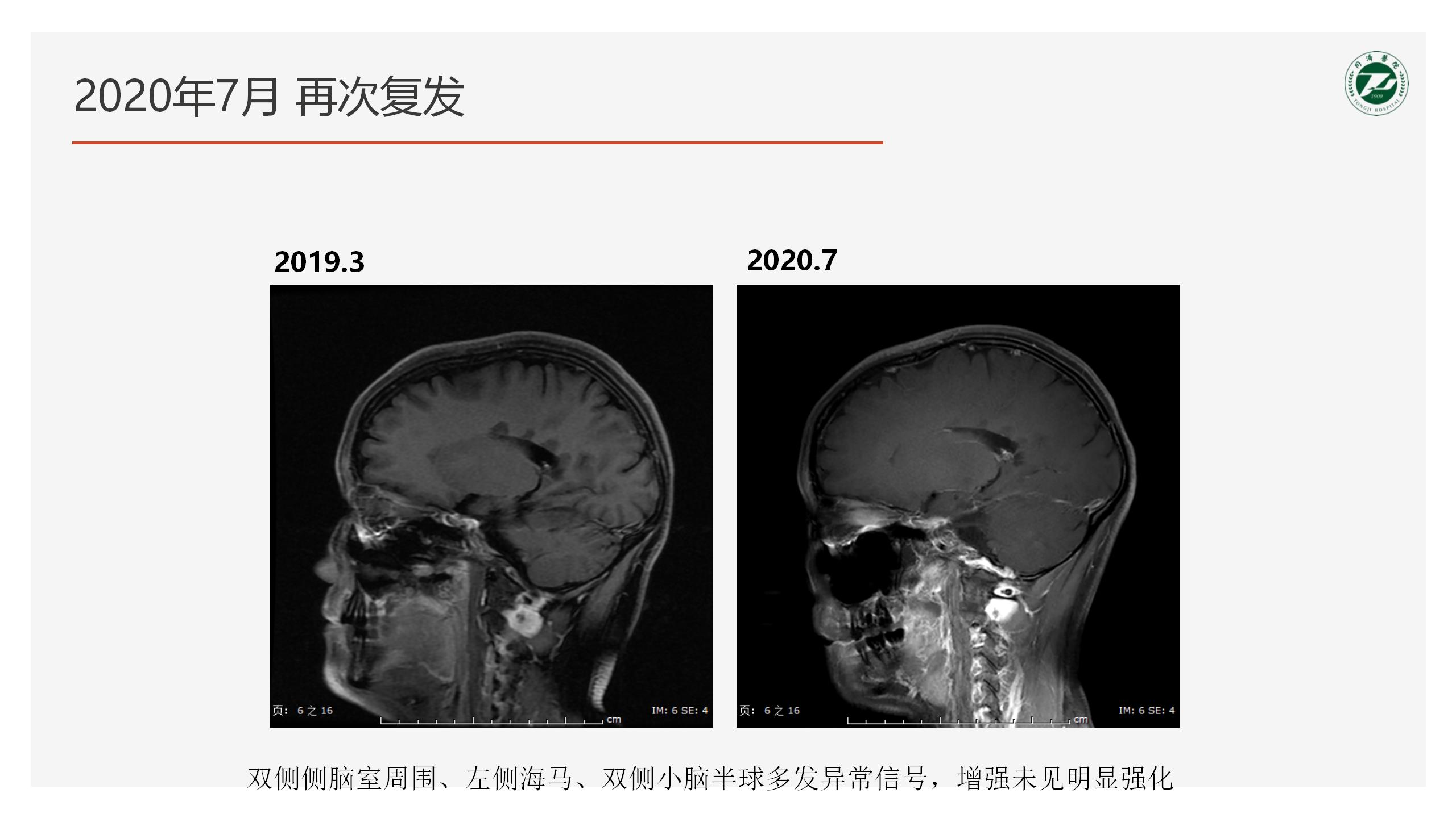 2023-4-21 奥巴捷区域沙龙《病例分享》黎钢_39.jpg