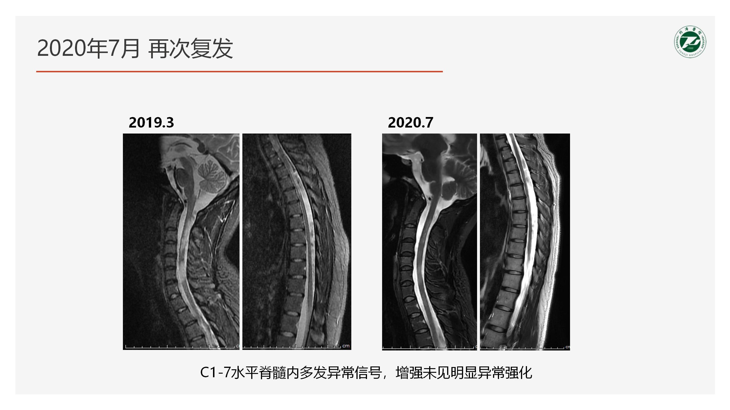 2023-4-21 奥巴捷区域沙龙《病例分享》黎钢_40.jpg