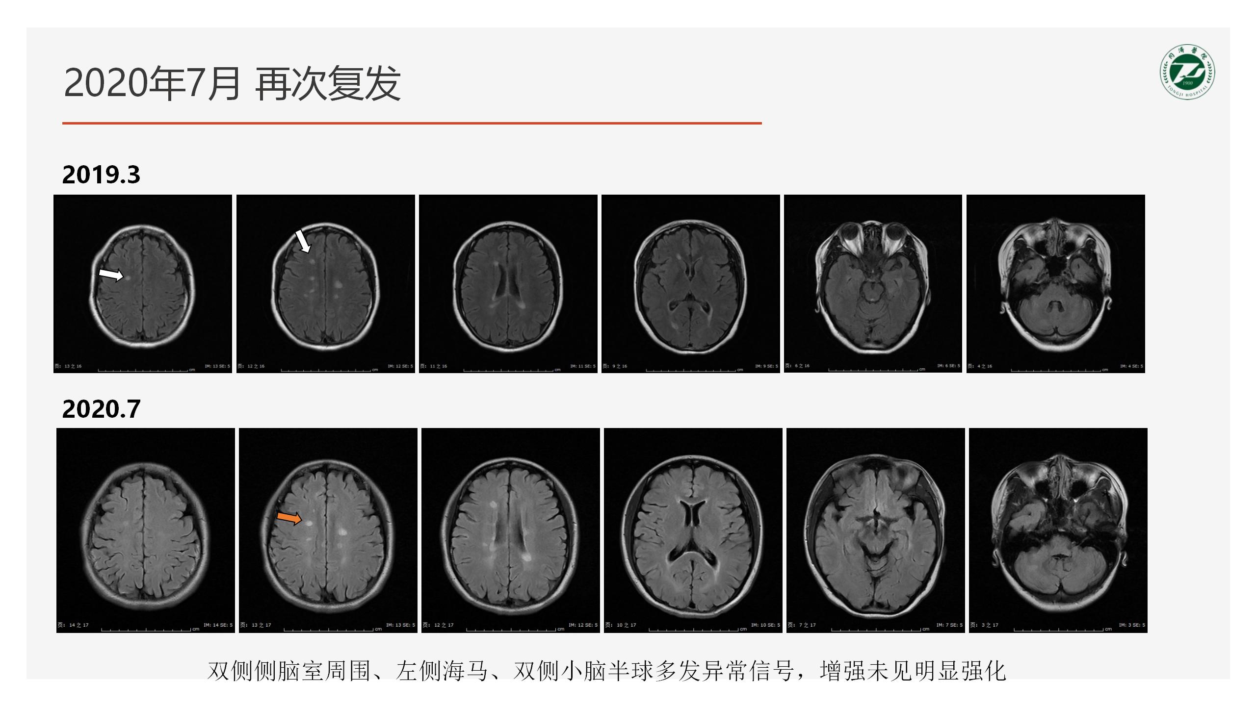 2023-4-21 奥巴捷区域沙龙《病例分享》黎钢_38.jpg