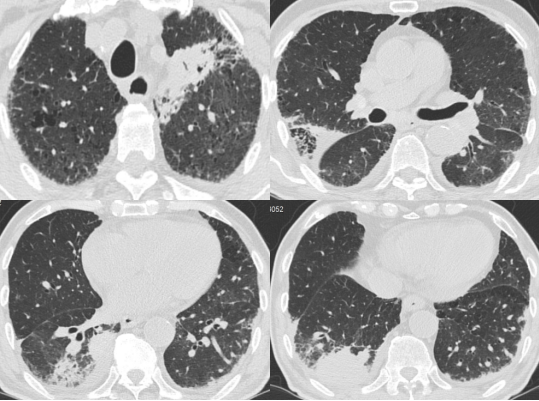 22 抗真菌治疗17天-HRCT（增强CT）（8-16）.png