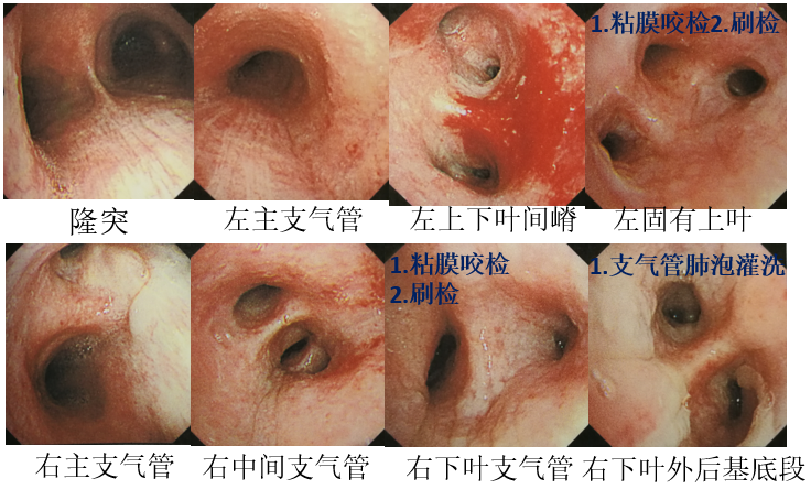6 纤维支气管镜（7-24）.png