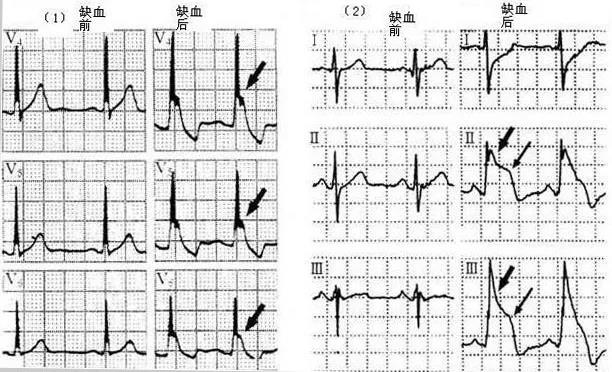 《心律》)(1)單純缺血性j波;(2)缺血性j波伴st段抬高