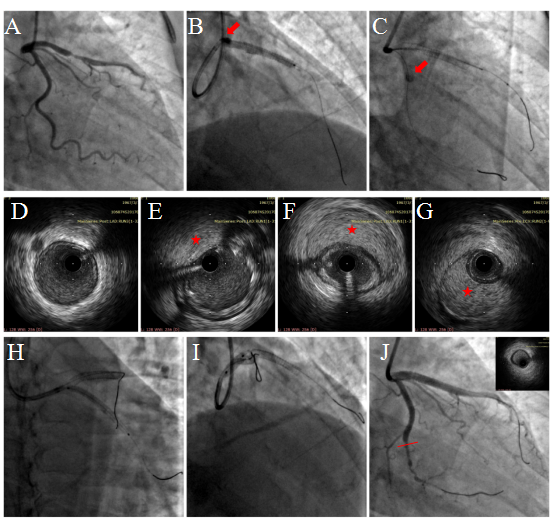 壹生资讯-【中山PCI解码·第22篇】自发性冠脉夹层的轻介入原则：规避血肿扩展陷阱