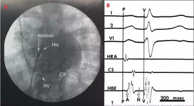 x线影像下各电极导管位置:高位右心房(hra),希氏束(his束),冠状静脉窦
