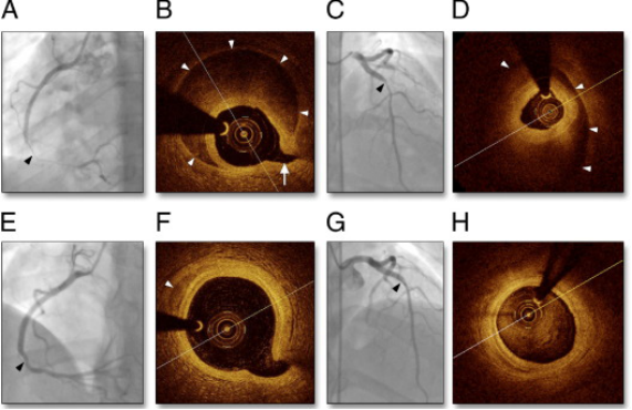 壹生资讯-【中山PCI解码·第20篇】自发性冠脉夹层的不介入原则：保守治疗是王道