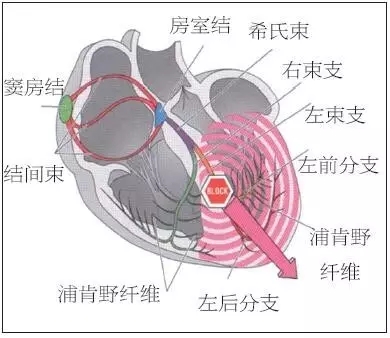 壹生资讯-【腔内心电图入门课】3张图，带您读懂左束支传导阻滞
