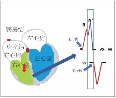 壹生资讯-【腔内心电图入门课】3张图，带您读懂左束支传导阻滞