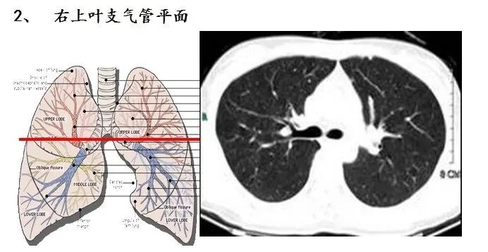 收藏ct肺段定位口訣圖文結合異常清晰