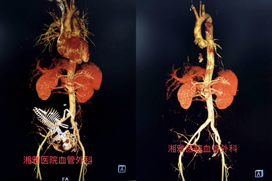 患者主动脉全长CTA成像术前（左）术后（右）对比图.jpg