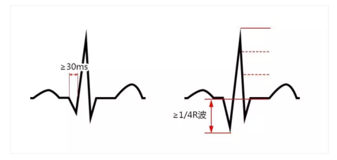 急性心梗确诊期:坏死型q波 首先,需要明确的是,何为病理性q波?