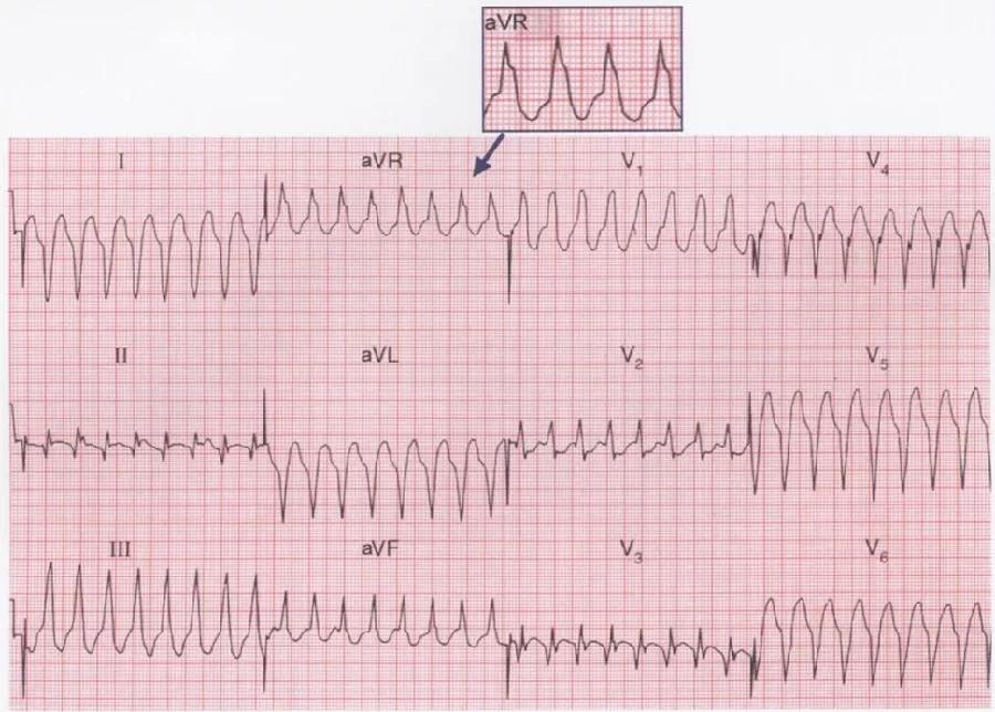 avr導聯起始r波型室性心動過速