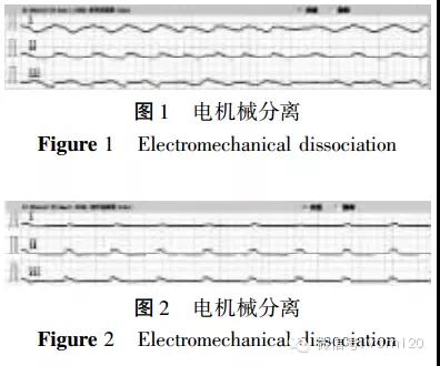 机械分离心电图图片