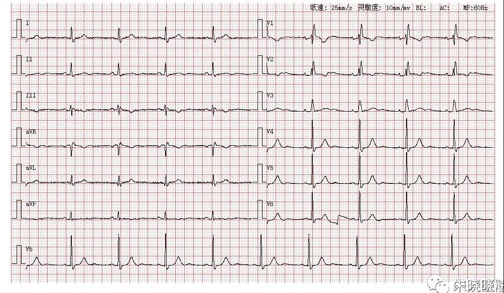 45岁男性,体检心电图发现异常