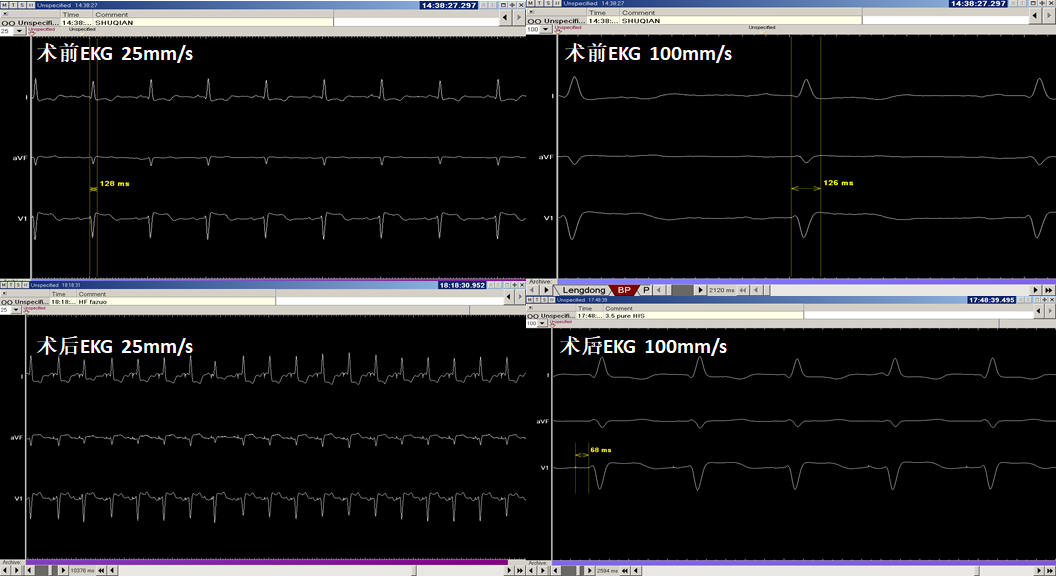 图10. 起搏器植入术后记录心电图与术前对比，提示术后心电图为完全起搏，QRS波不宽，与术前基本一致,仅心律增快（心衰发作）。.png